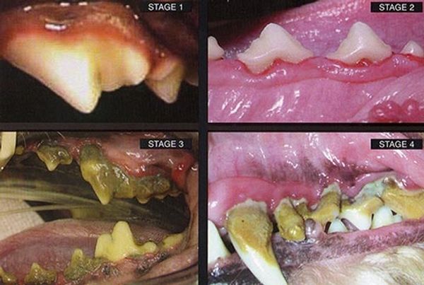 A periodontal disease 4-stage dental chart showing why regular cleanings matter